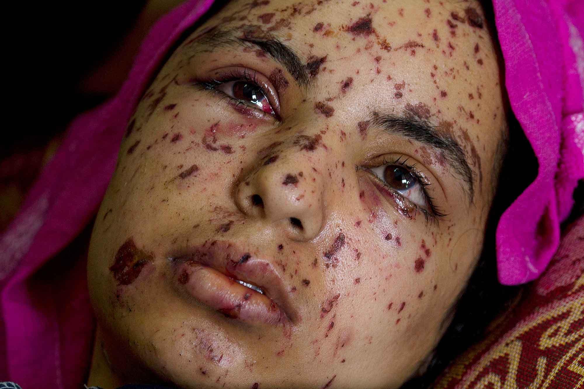 Wounded Palestinian Rawya abu Jom’a, 17 years old, lays in a hospital bed at the Al Shifa Hospital in Gaza City July 22, 2014. Rawya was seriously injured when two Israeli air strikes hit her family's apartment. Three of her cousins and her sister were ki