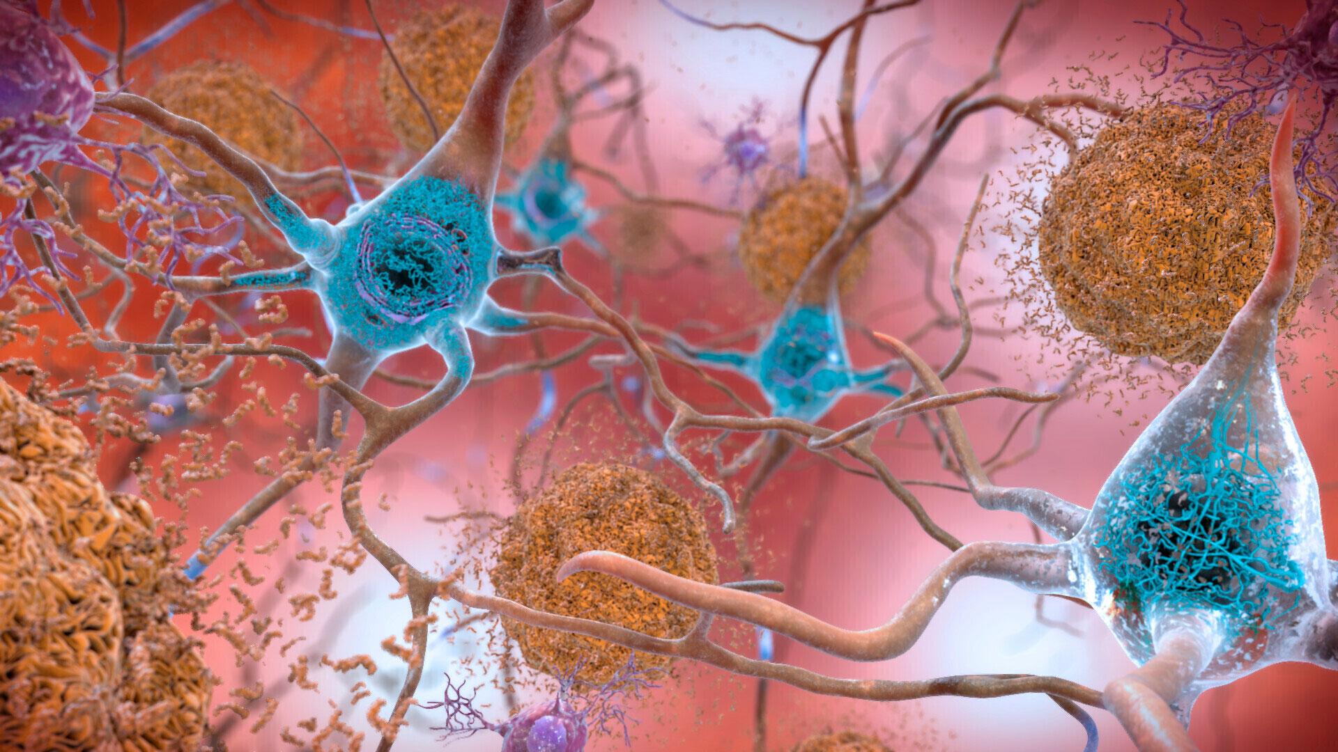 This illustration made available by the National Institute on Aging/National Institutes of Health depicts cells in an Alzheimer’s-affected brain.