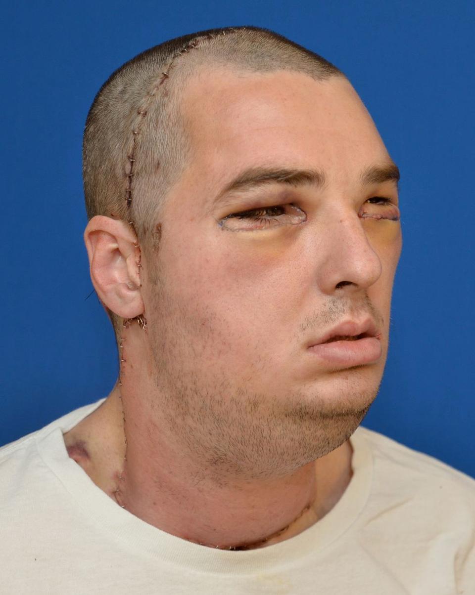Richard Norris receives most extensive full face transplant to date