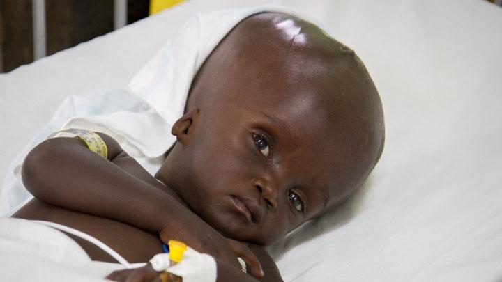 Blessing, a young girl from South Sudan, recovers from surgery to treat hydrocephalus. Fluid builds up in the brain causing the head to swell.