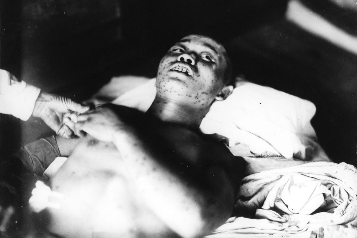 A 21-year-old soldier, who was exposed to the atomic bombing of Hiroshima and has purple subcutaneous haemorrhage spots on his body, is treated at the Ujina Branch of the Hiroshima First Army Hospital.