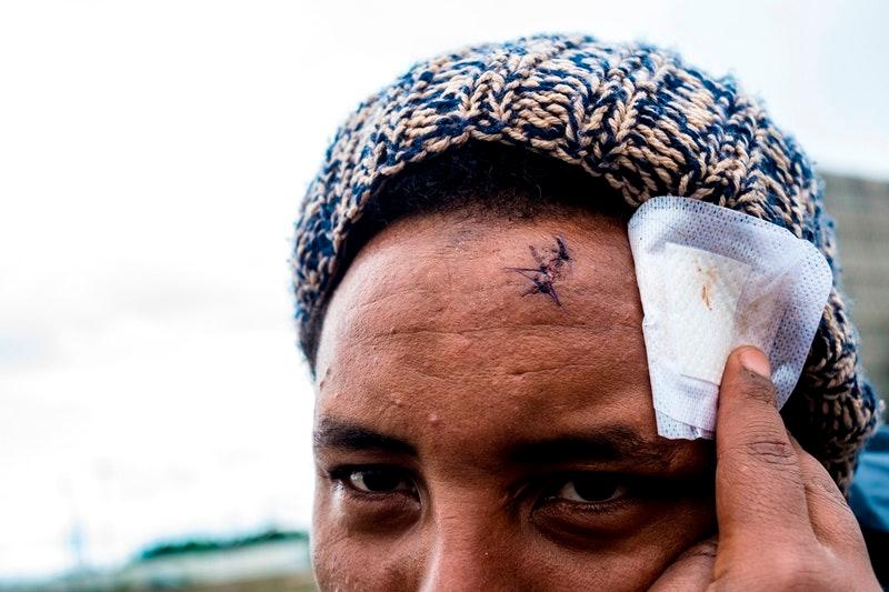 Qeraso shows his head wound after he fell escaping police, July 25, 2017.