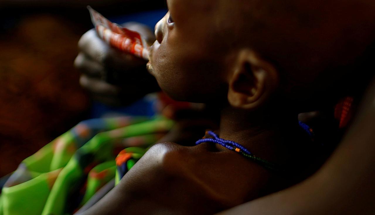 South Sudan famine malnutrition