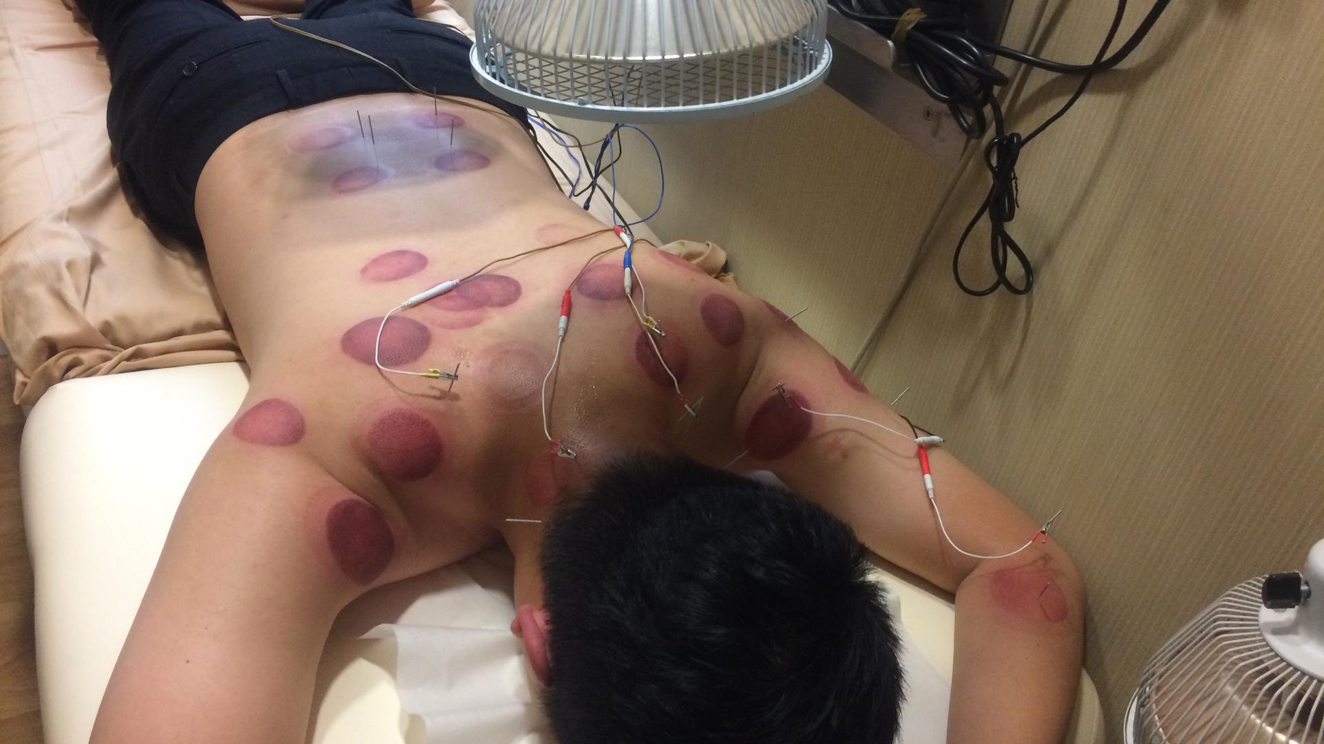 dark, purple circles are a visible result of cupping, another alternative treatment