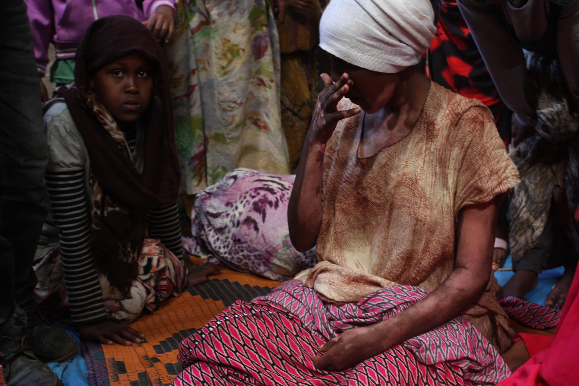 This woman at a camp for displaced Oromo outside Harar, Ethiopia, says she suffered burns on her arms and neck during her eviction from the Somali region.