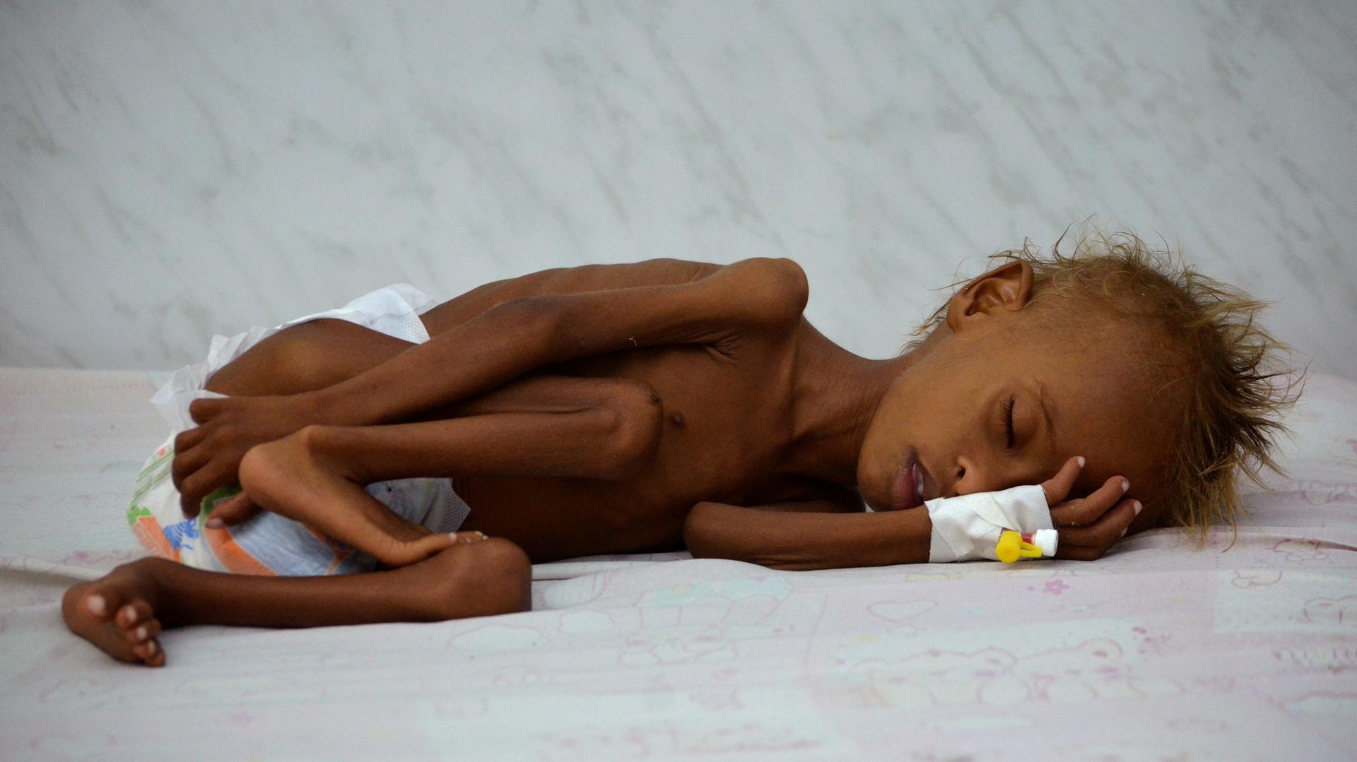 Salem Abdullah Musabih, 6, lies on a bed at a malnutrition intensive care unit at a hospital in the Red Sea port city of Hodaida, Yemen, Sept. 11, 2016. Millions of Yemenis face food shortages and the threat of famine after more than two years of civil wa