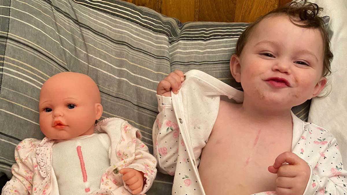 Two-year-old Lula-Belle Butler-Wenlock-Simpson, right, who was born with heart problems and underwent open-heart surgery, poses with a Special Friends doll whose scar mirrors her own.