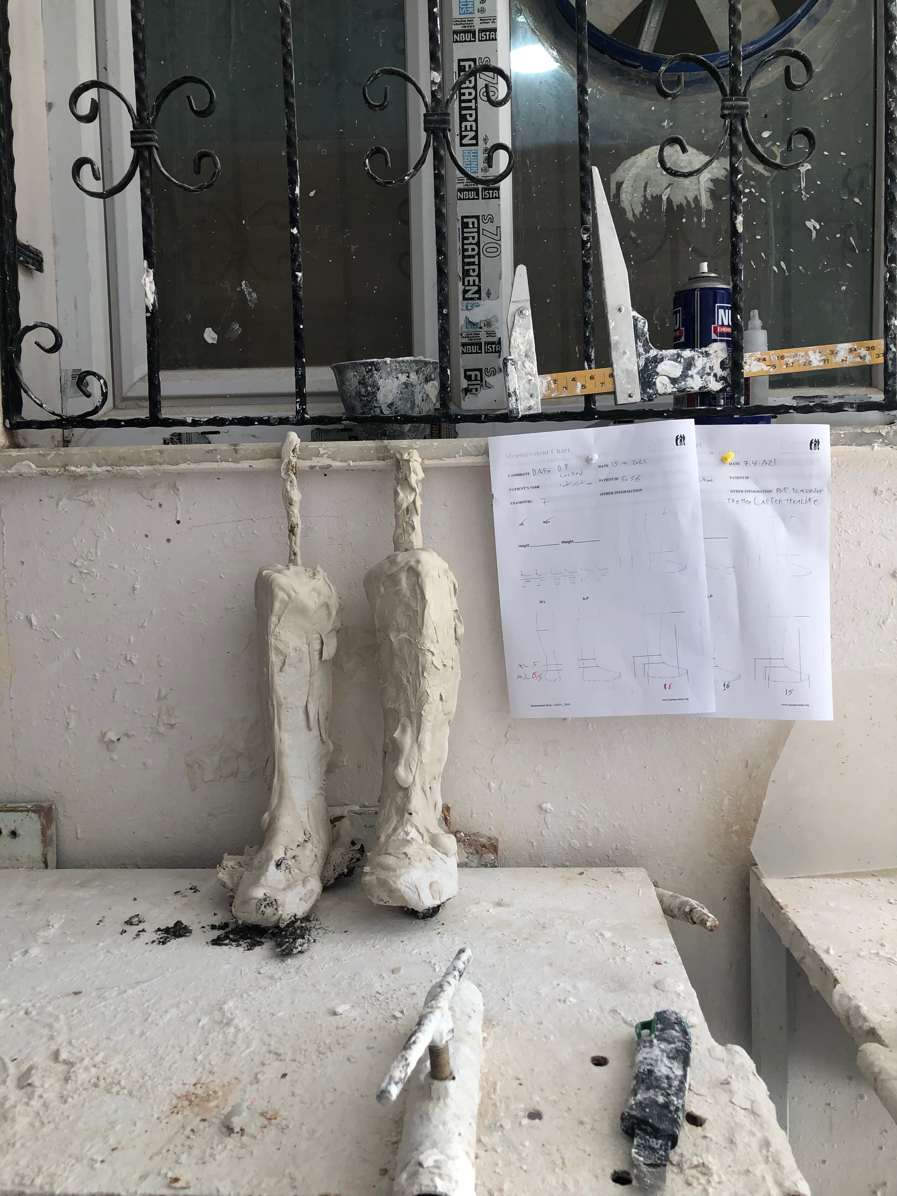 Temporary cast of Jad's legs at the workshop at the NSPPL center in Reyhanli, Turkey. Specialists will use these to make the permanent braces that will help Jad walk.