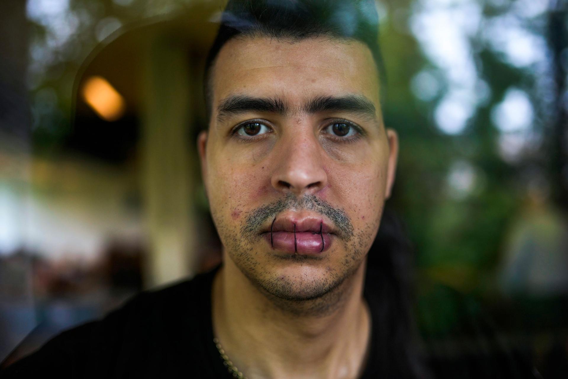 A close up portrait of a man who has sewn his lips together with three stitches.