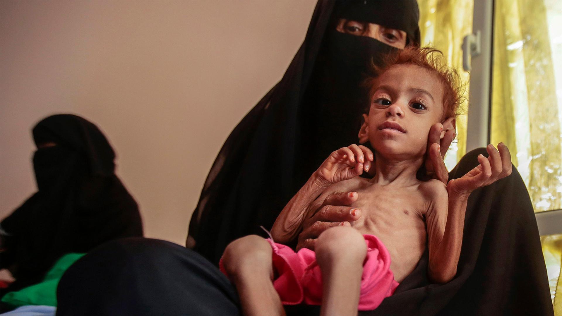 A woman holds a malnourished boy at the Aslam Health Center, in Hajjah, Yemen
