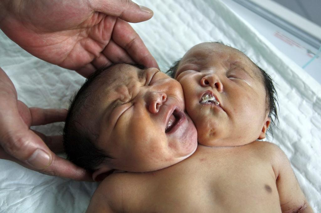 Conjoined twins in China