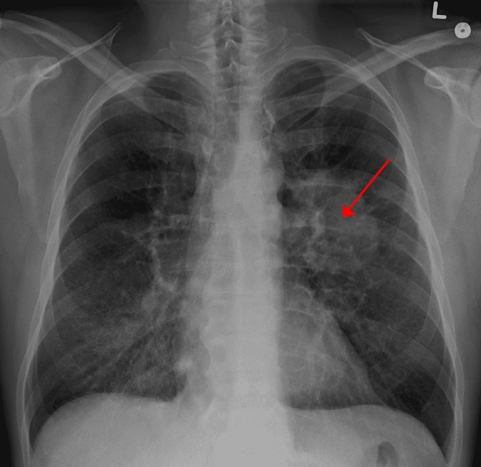 Chest x-ray shows lung