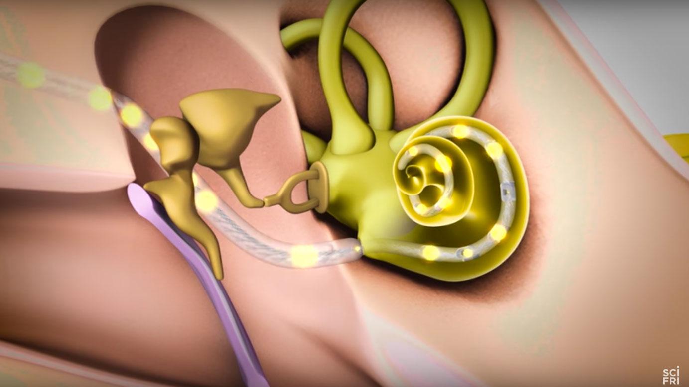 A screengrab from "Breakthrough: A Re-Sounding Remedy" showing a new technique to improve cochlear implants.