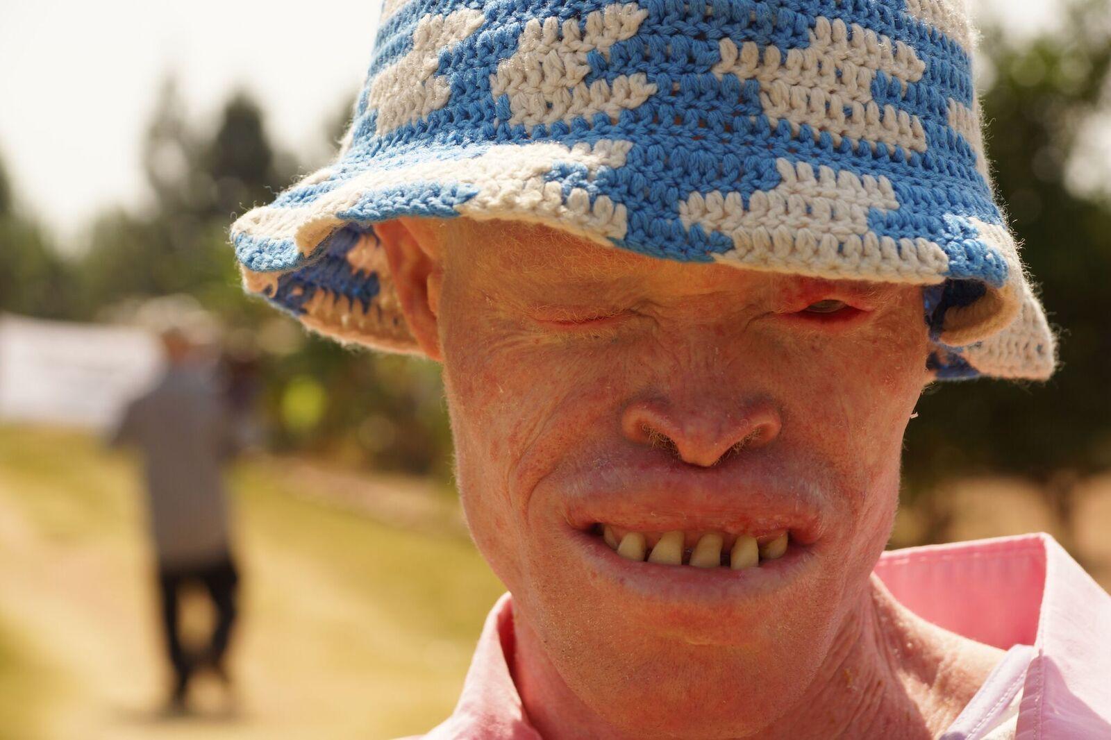 Musa of the Tanzania Albinism Collective