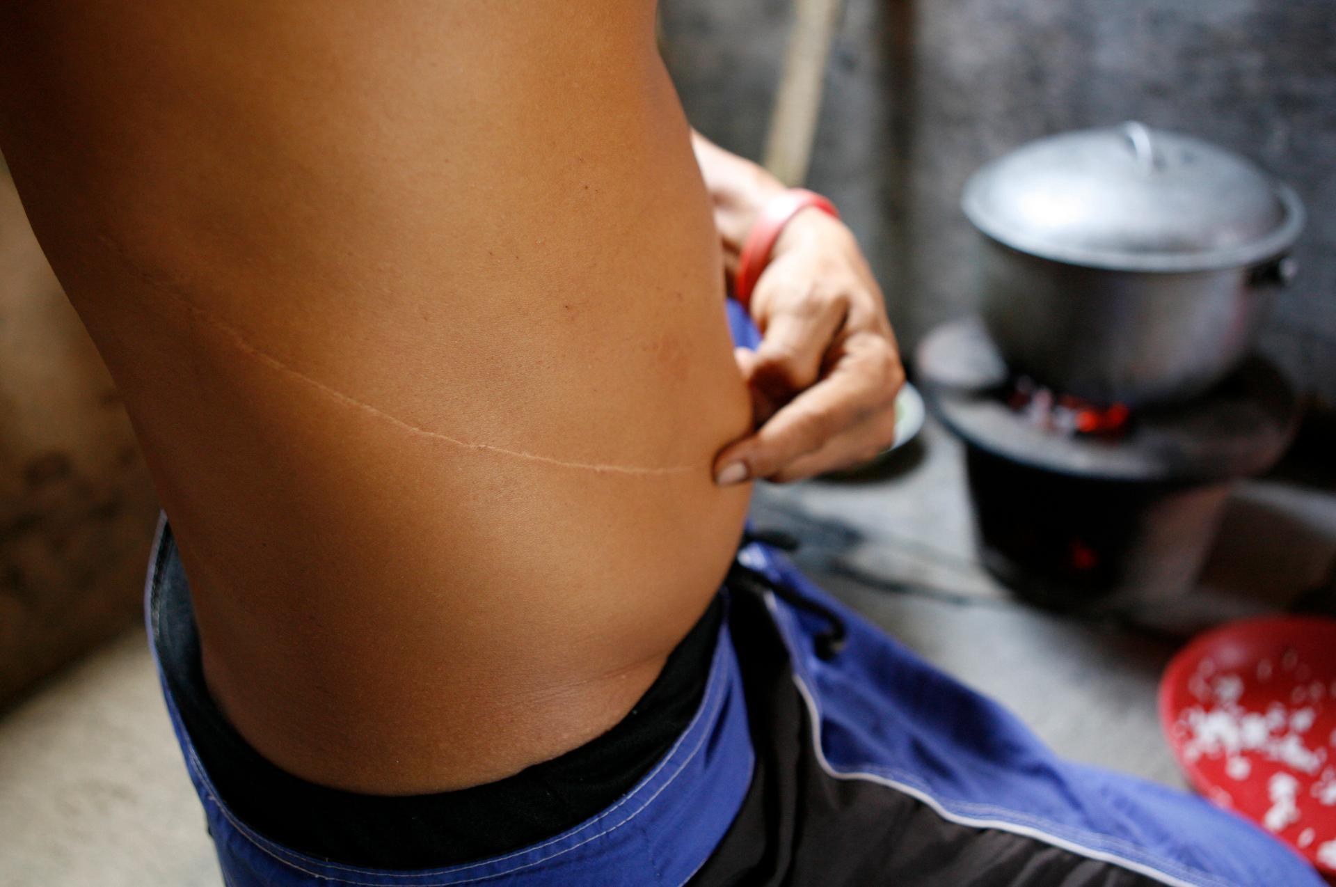An unidentified Filipino man who sold his kidney for a transplant shows his scar while cooking at his home in a slum of Manila.