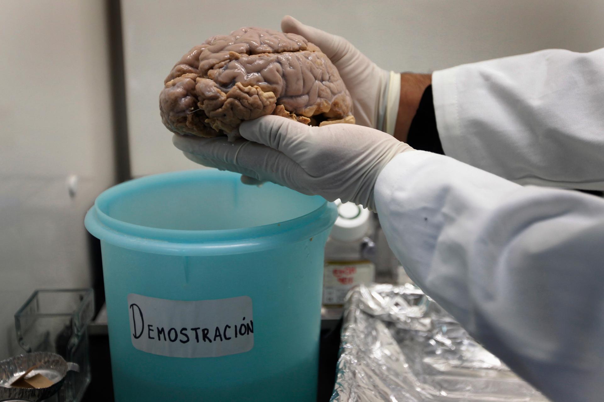 Jose Luna, an Alzheimer's researcher, shows an Alzheimer's patient's brain at Insituto Politecnico in Mexico City.