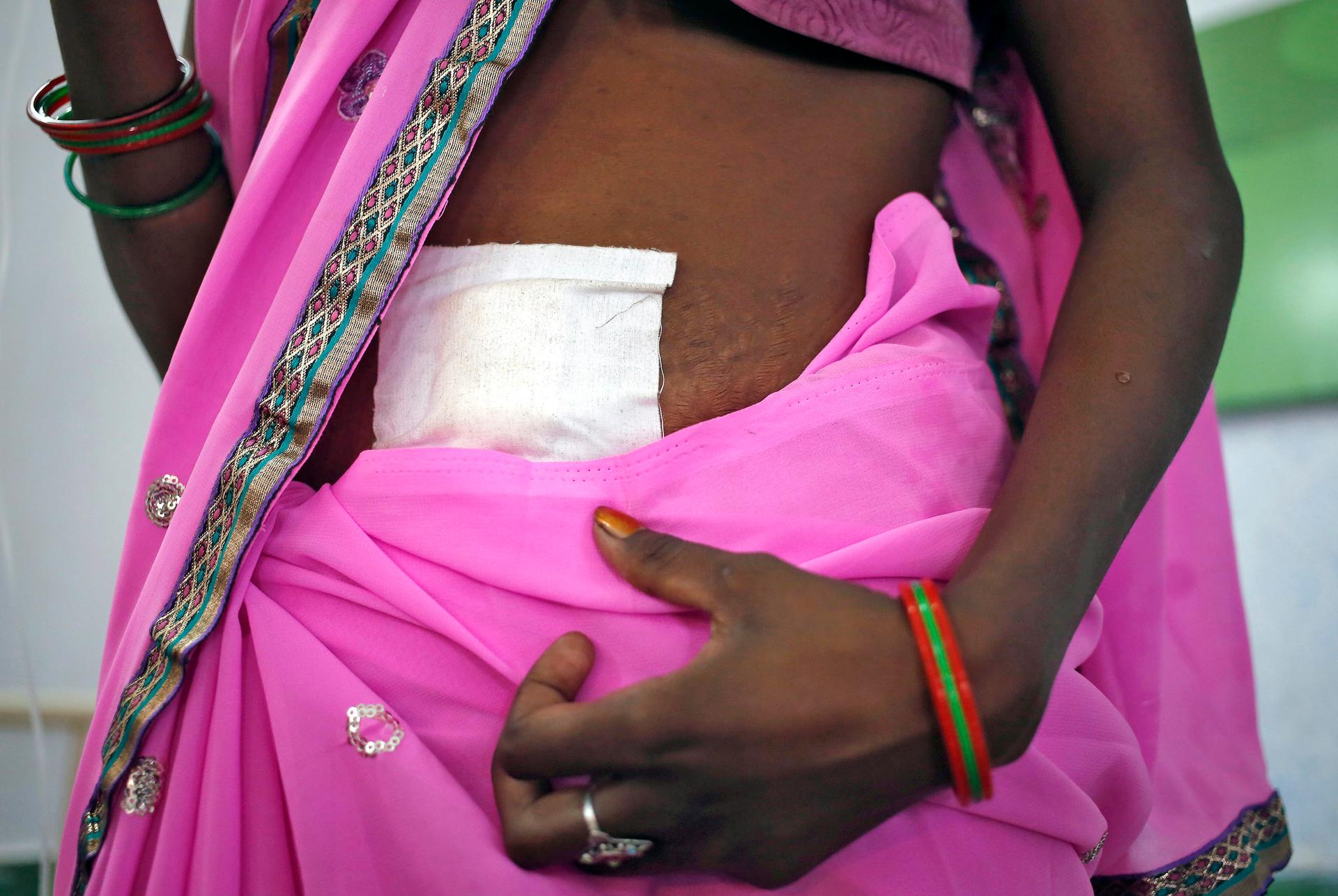A Indian woman, who underwent sterilization surgery at a makeshift government facility in the Indian state of Chhattisgarh where at least 13 women died. 