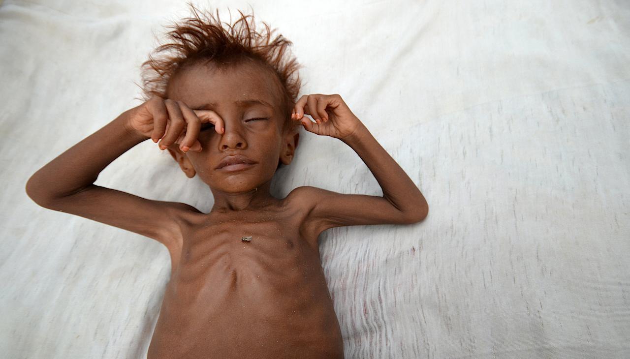 Yemen famine child