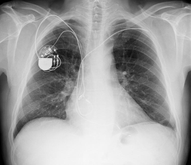 A chest X-Ray showing a pacemaker.