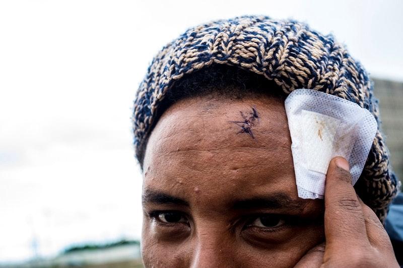 Qeraso shows his head wound after he fell escaping police, July 25, 2017. 