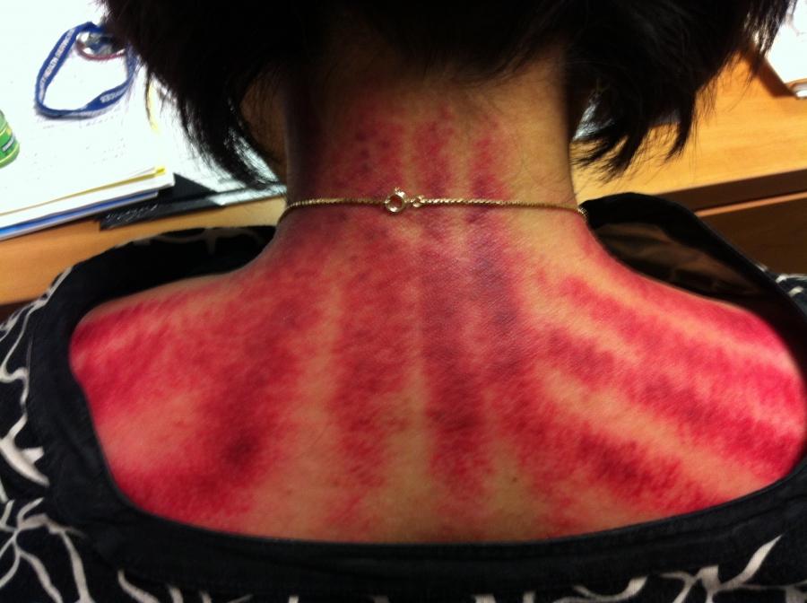 Coining therapy marks, which appear like tiger-red stripes, are seen on a patient's back.