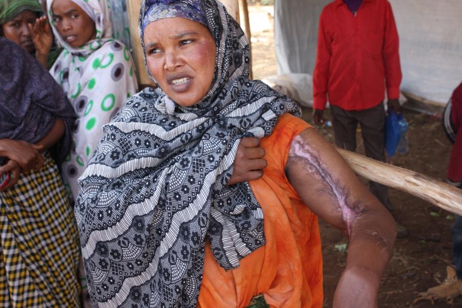 At a camp for displaced Somalis in Kolenchi, this formerly prosperous businesswoman from Aweday was burnt during the riot and lost everything she owned.