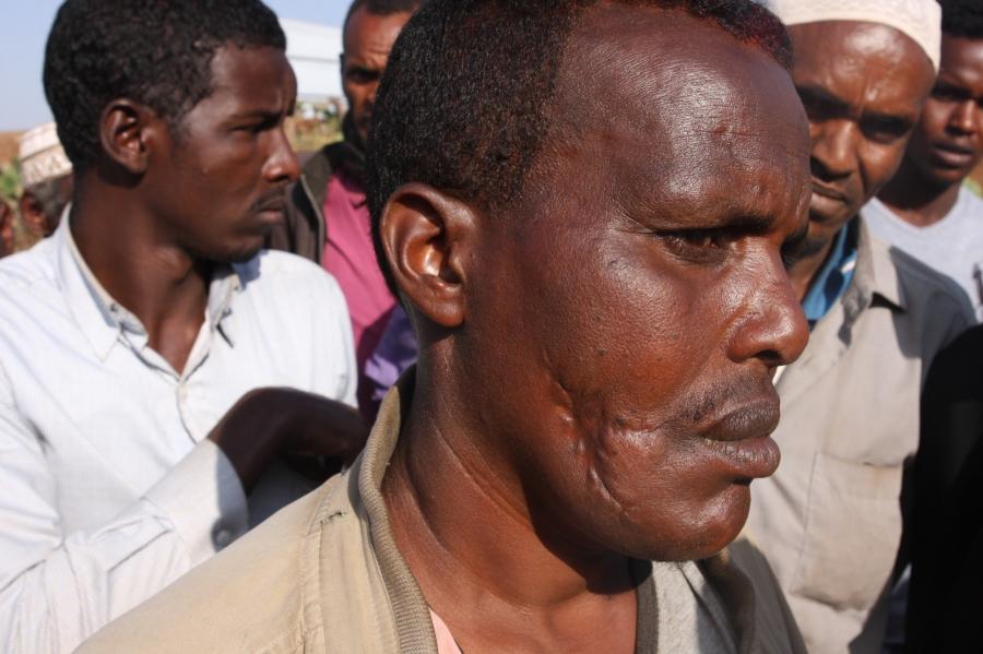 At a camp for displaced Somalis in Kolenchi, this man was allegedly shot in the face by Oromo police. On the other side of his face are other bullet wounds from when the police shot him while he was lying on the ground afterwards. 