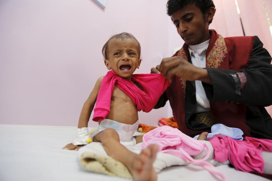 A man dresses his malnourished daughter at a malnutrition intensive care unit in Yemen