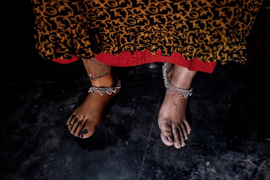 Close up of Arati Baladas' feet. She has a prosthetic foot.