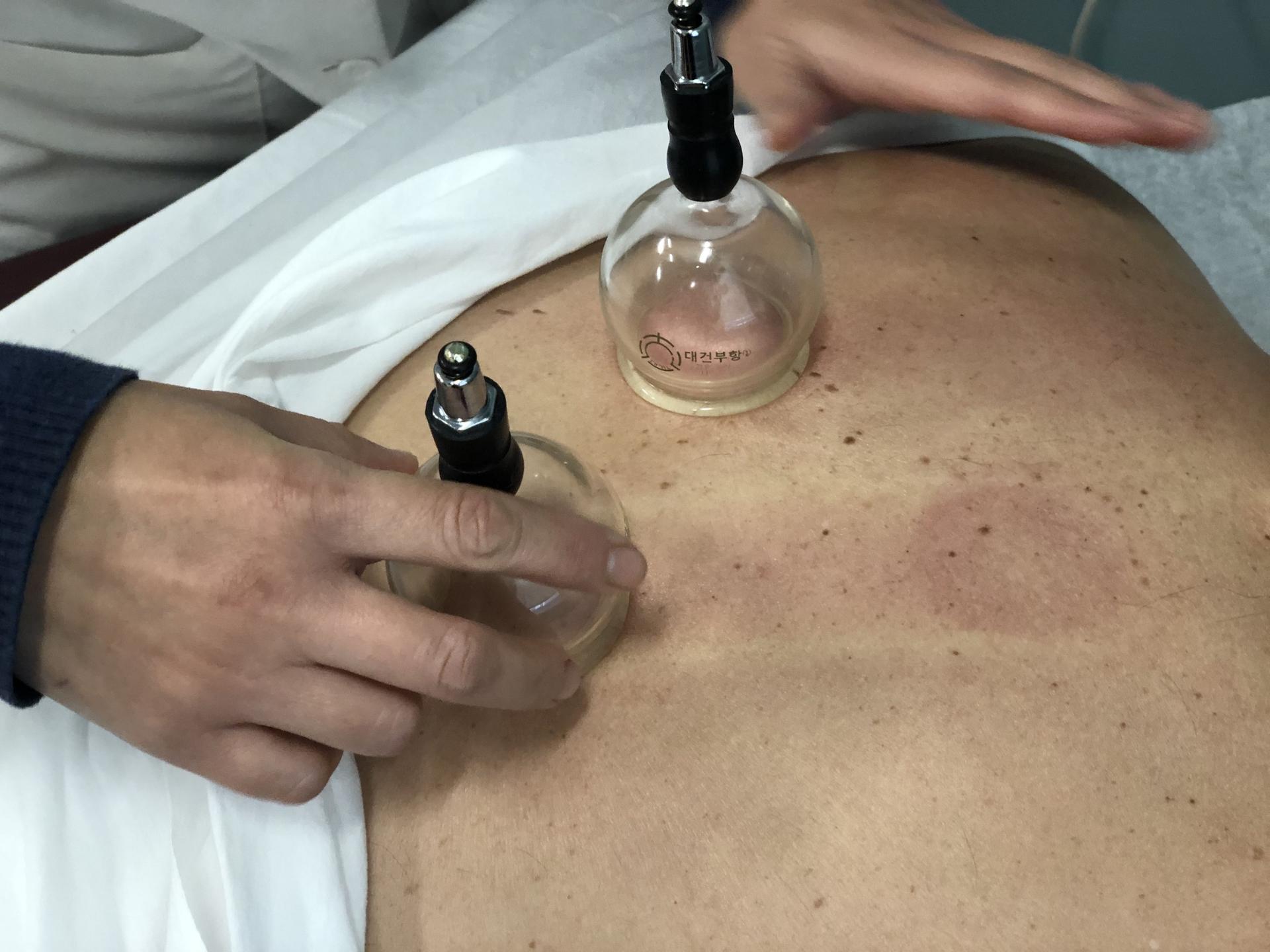 Quan Zhou, a traditional Chinese medicine practitioner, performs a cupping procedure on a patient's back at the New England School of Acupunctu