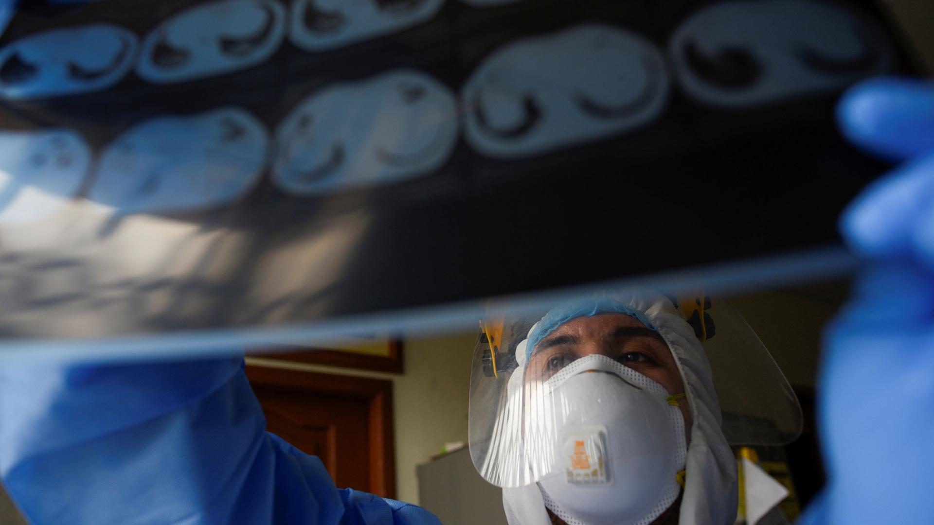 A doctor is shown wearing protective medical clothing and a face shield while holding up a X-ray photo of a patient's lungs.